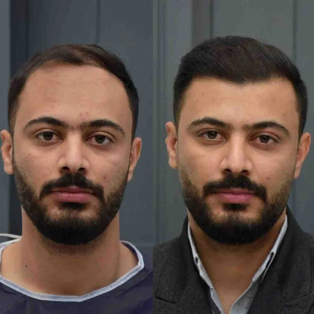 قبل و بعد کاشت مو